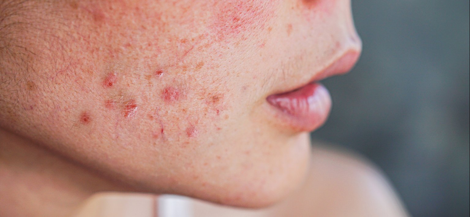 Acne-Prone - Husk & Seed