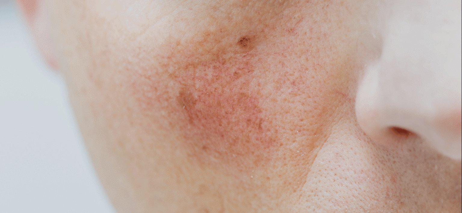 Rosacea - Husk & Seed